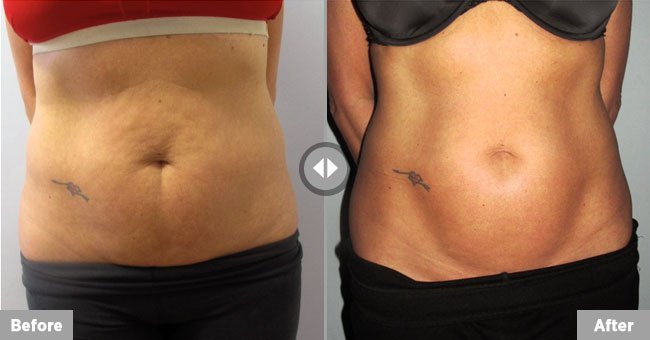 Body Contouring Before After