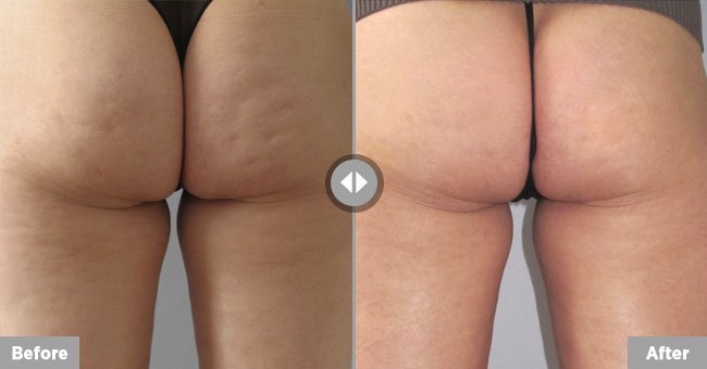 Body Contouring Austin, TX Before After