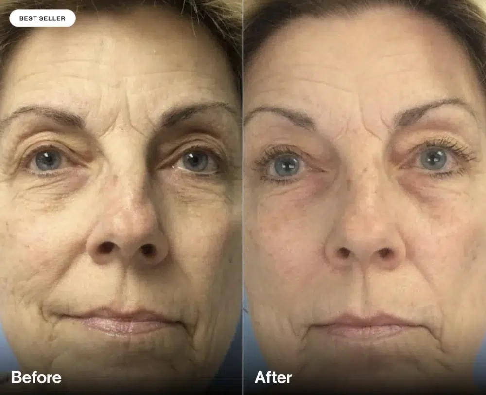 Before and after LED red light therapy for fine lines and wrinkles at Veritas Backstage Austin