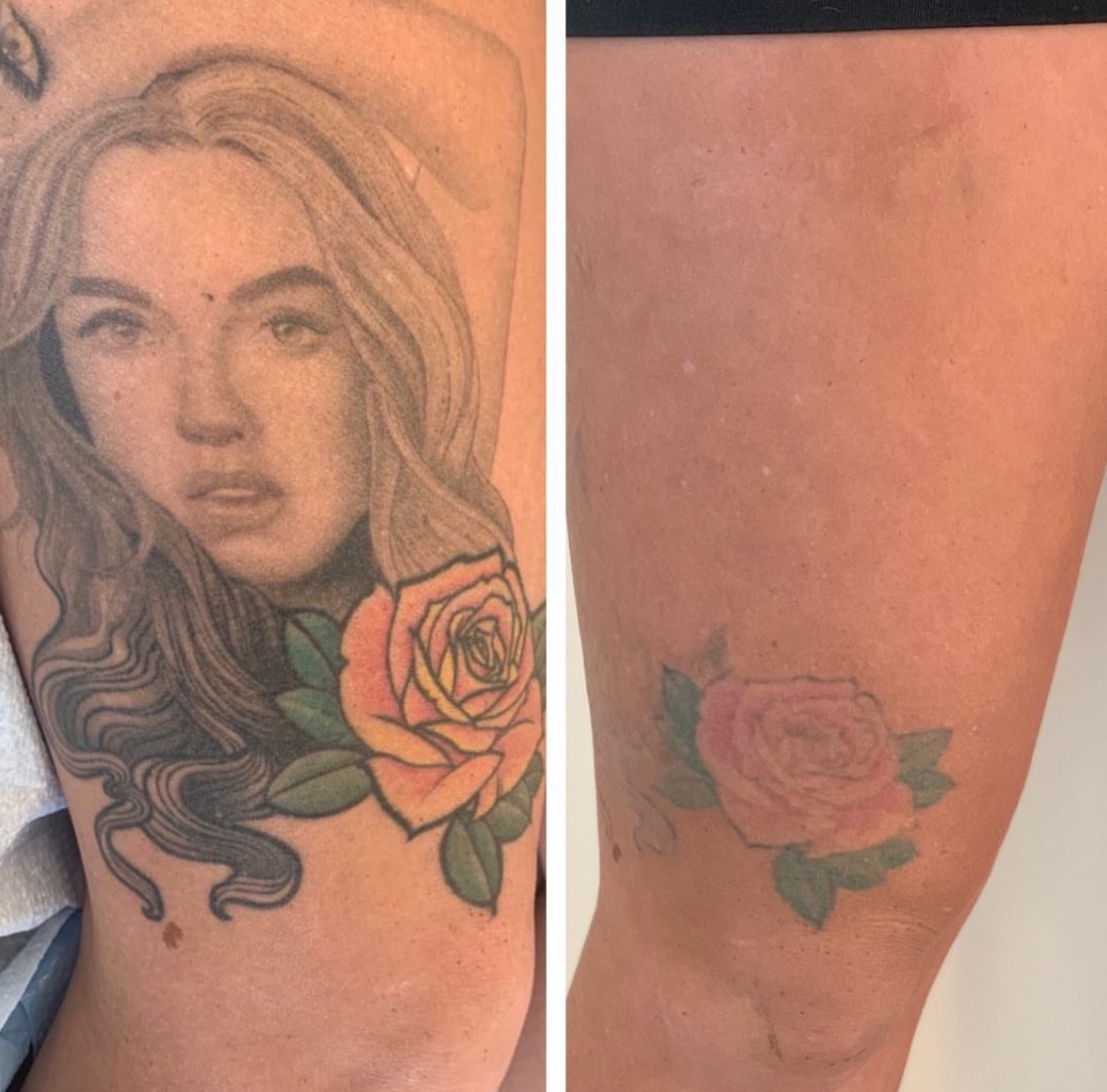 Tattoo removal before and after showing fading results