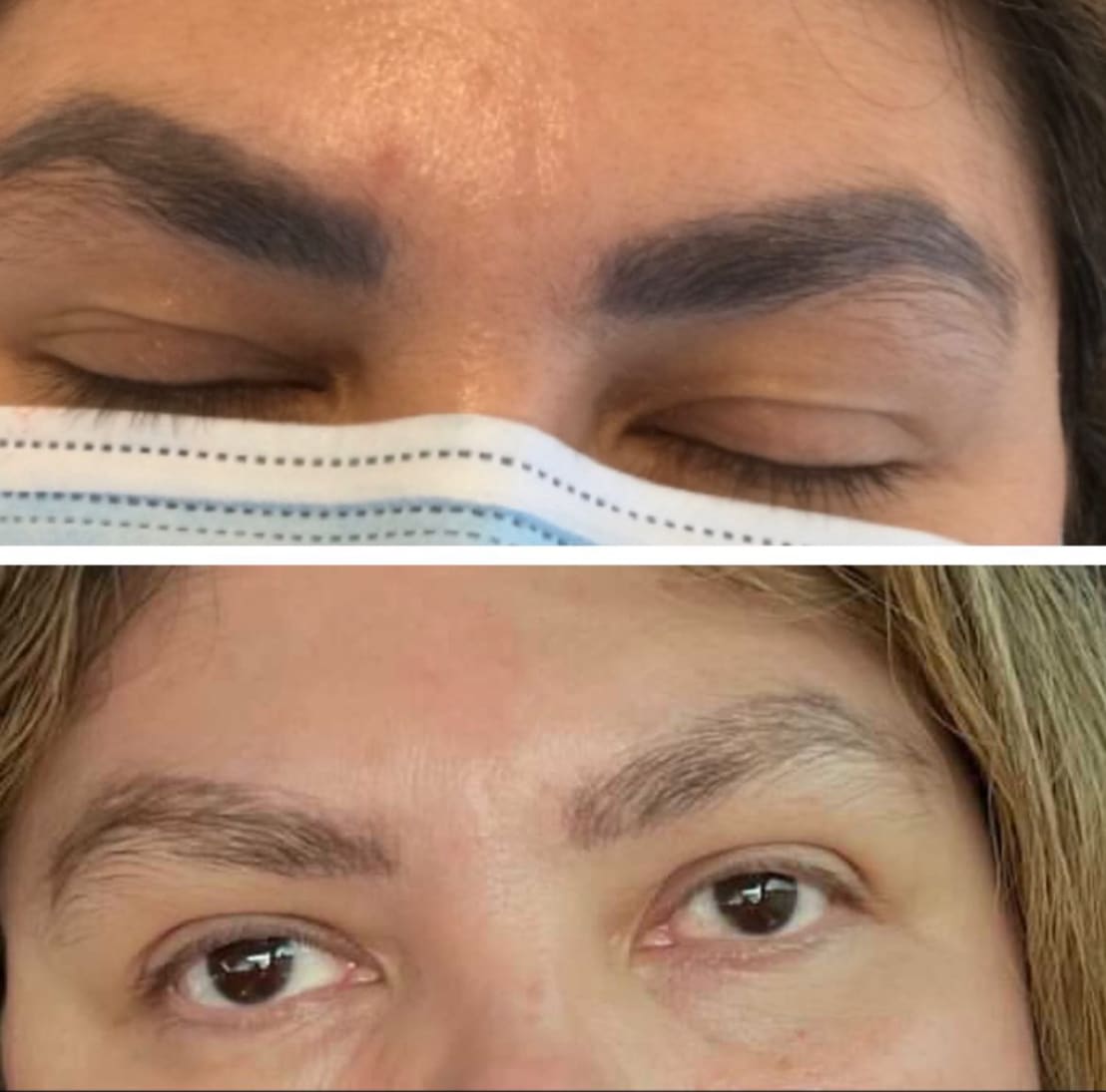 Tattoo removal treatment results showing pigment reduction