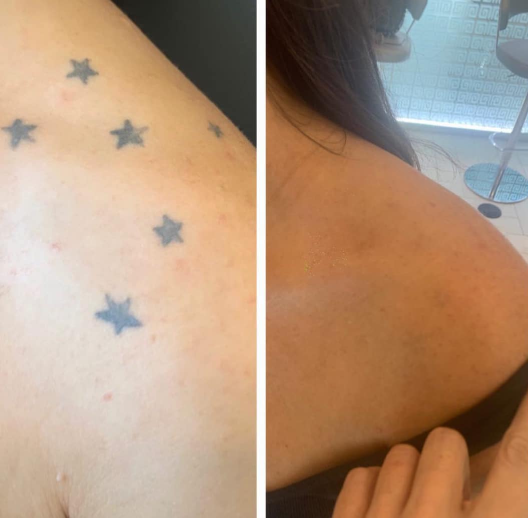 Tattoo removal progress photo showing treatment results
